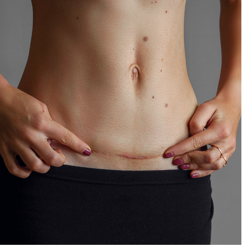 abdomen with cesarean scar and hands pointing to it