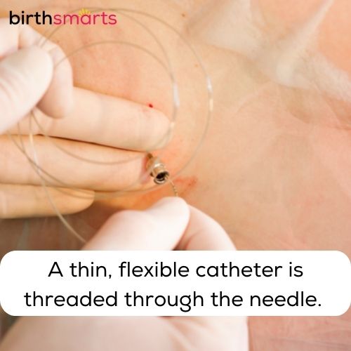 person's gloved hands threading a thin epidural catheter through needle in back