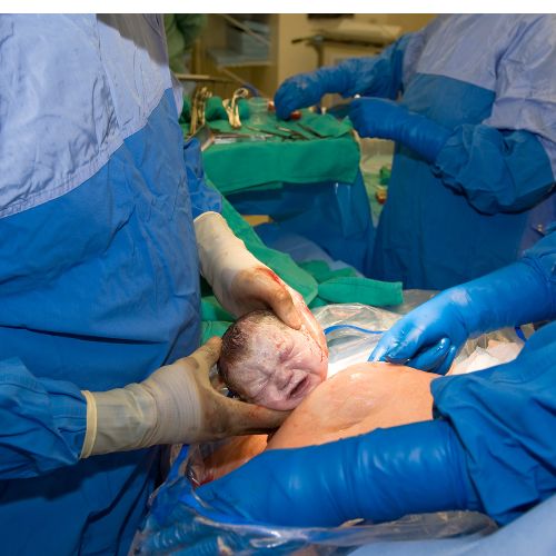 baby's head being delivered through an abdominal incision during a c-section